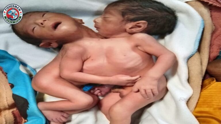 अलीगढ़ में दो सिर और चार हाथ-पैर वाले जुड़े जुड़वा बच्चों